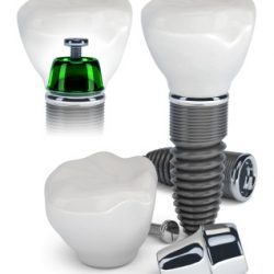 Dental Implant construction